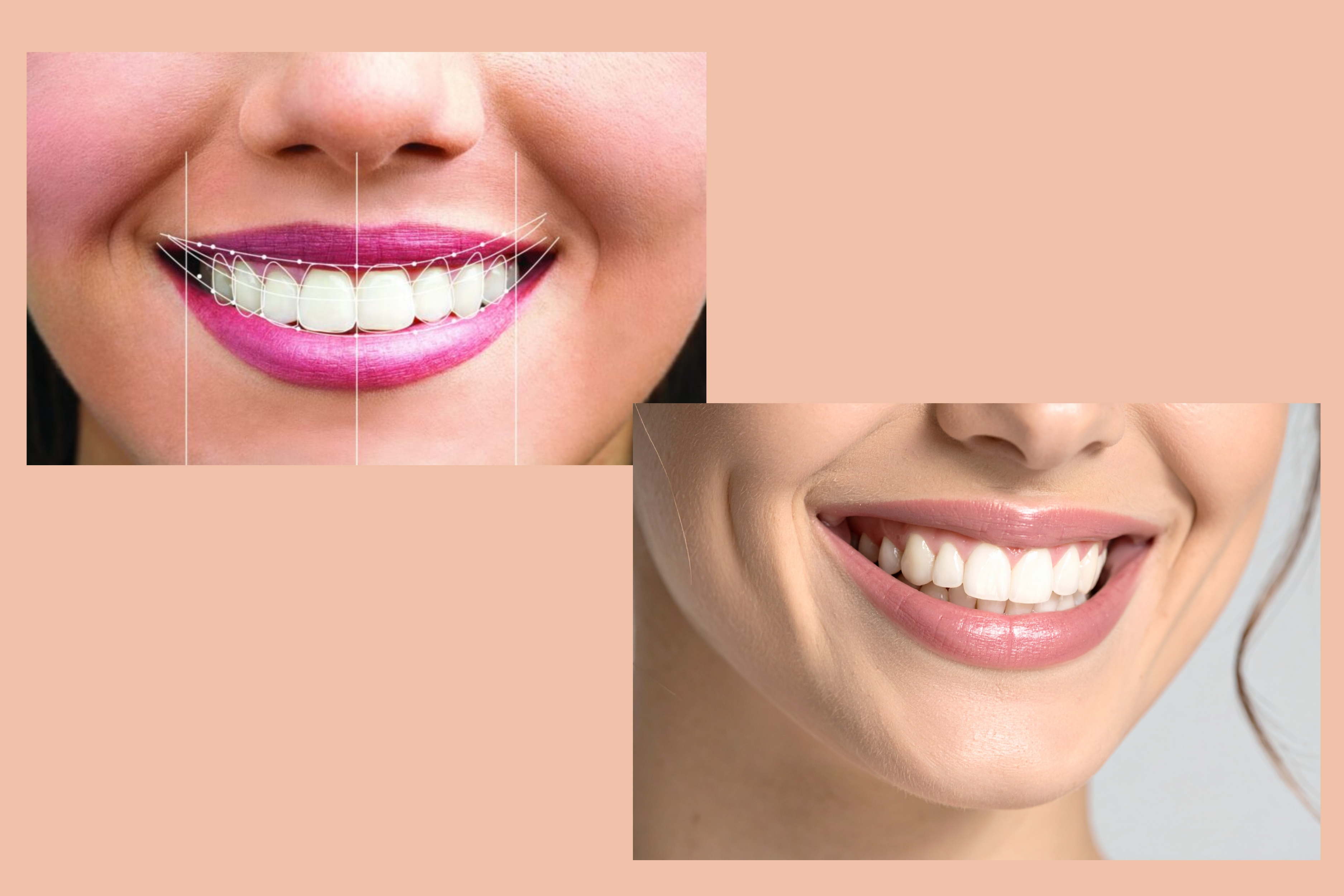 Smile Designing and Cosmetic Dentistry