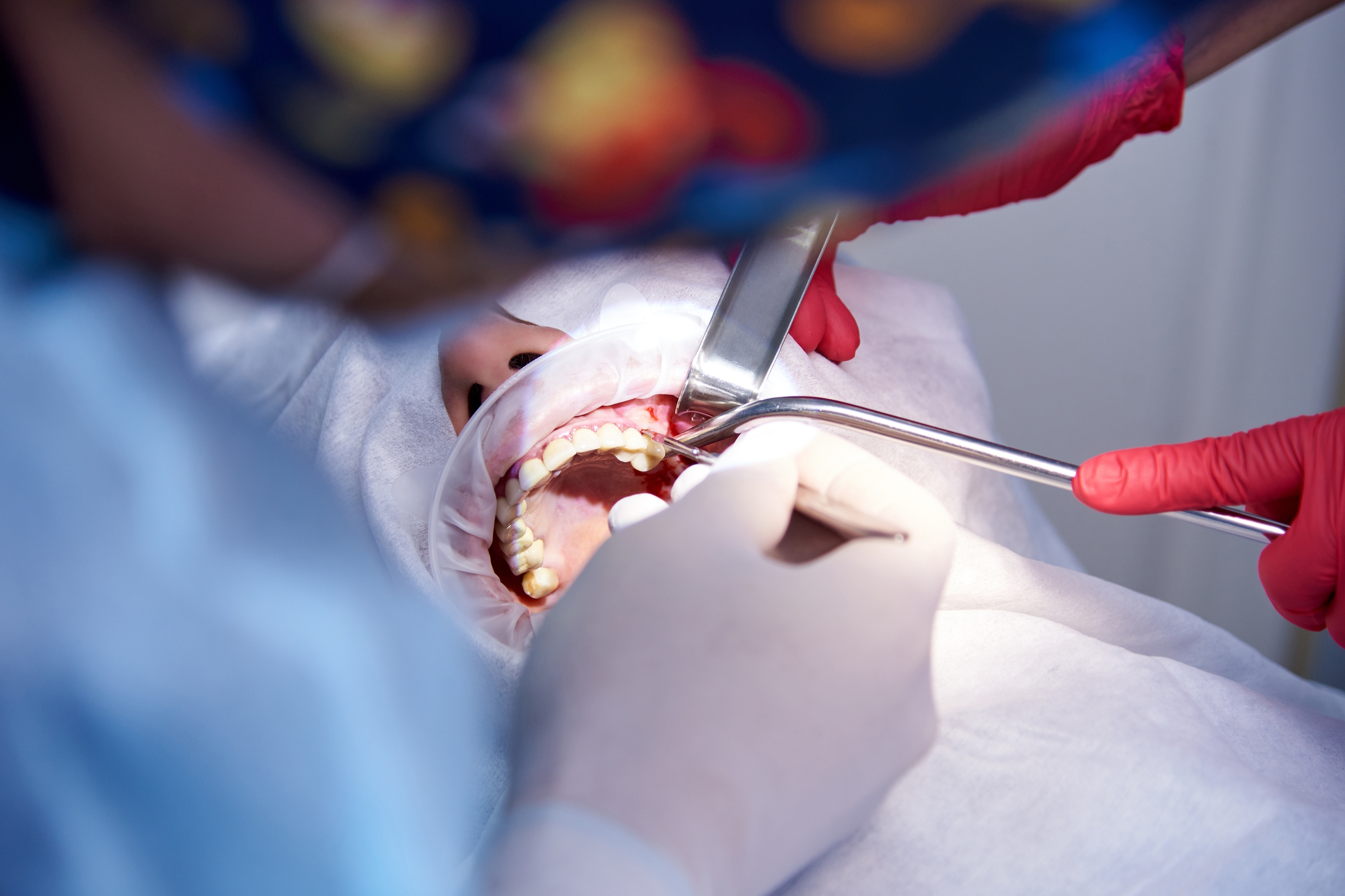 Full Arch Dental Implants