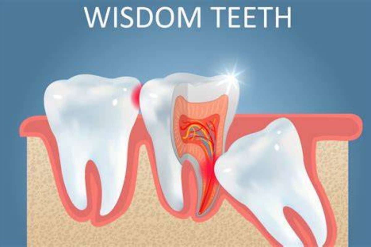 Wisdom Tooth Removal Surgery