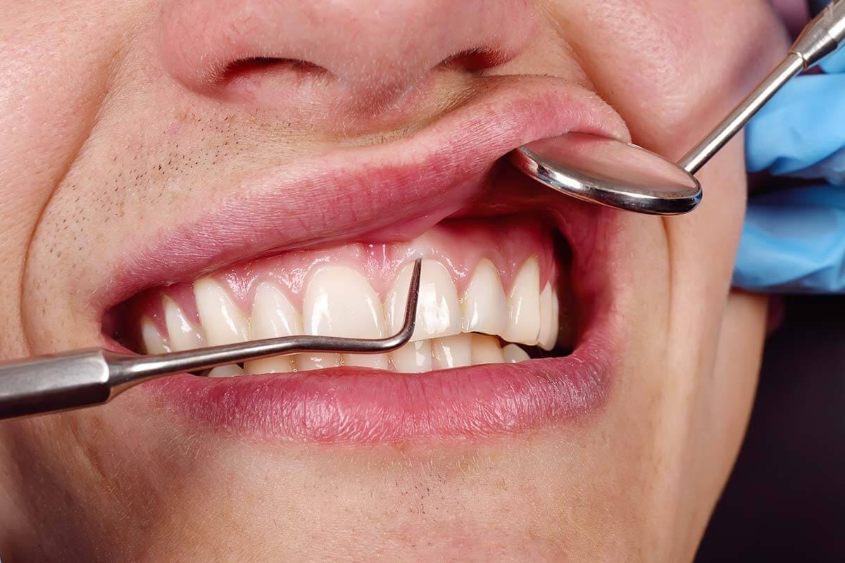 Gum Treatment